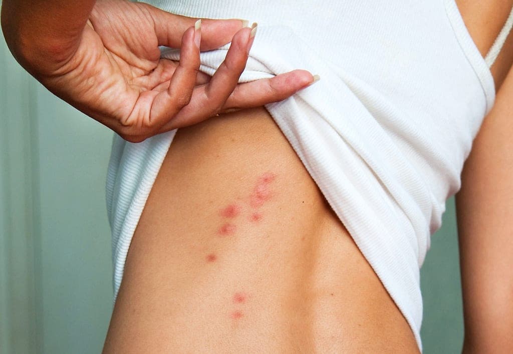 Bed bug bites on the skin, usually the first sign a guest reports